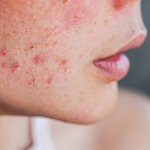 Acne break