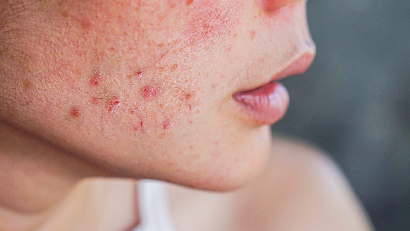 2 tips for Malaysians to be free from acne break